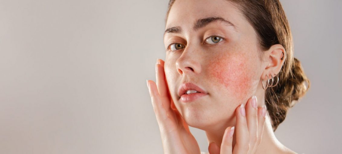 Rosacea kezelés